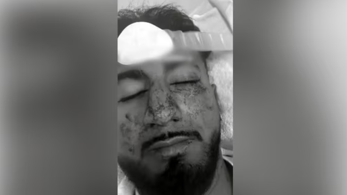 ऑस्ट्रेलिया में भारतीय छात्र पर नस्लीय हमला, पार्किंग विवाद को लेकर मारपीट; आई गंभीर चोटें